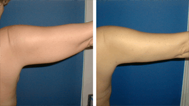 Arm Wing Fat Reduction