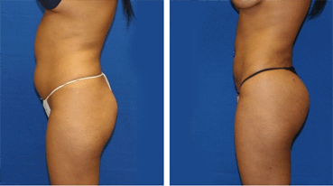 Abdominal Sculpting and Buttock Fat Transfer