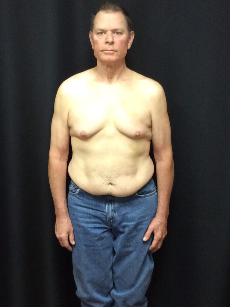 After Image: Weight Loss - front
