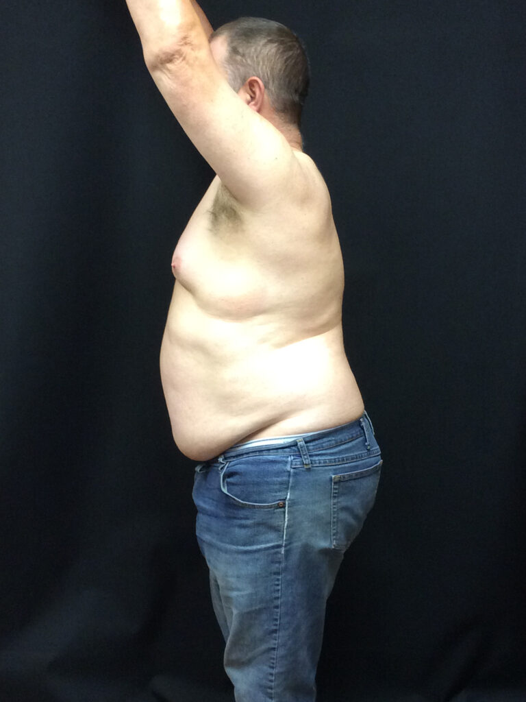 Before Image: Weight Loss - left-side