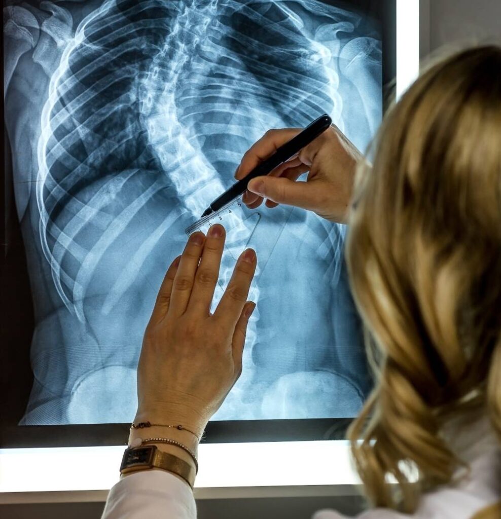 X-ray showing degeneration causing chronic back pain